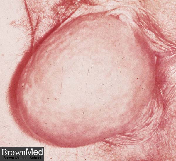 THIS IS WHAT I WAS SICK WITH. Bartholin Cyst 